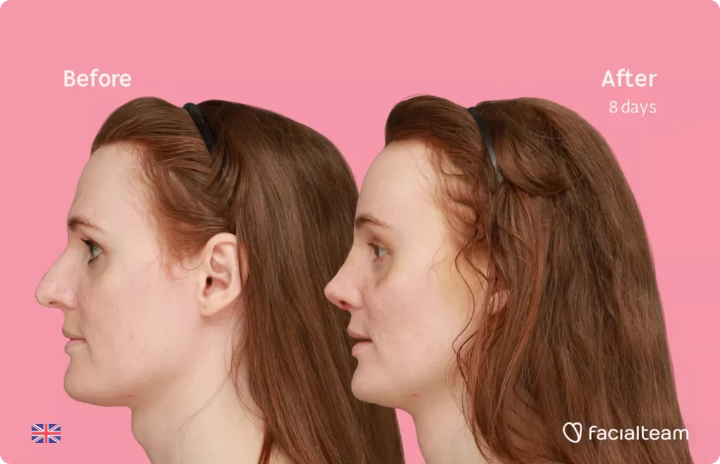 Side image of FFS patient Charlotte R showing the results before and after facial feminization surgery with Facialteam consisting of tracheal shave, forehead, rhinoplasty feminization surgery.