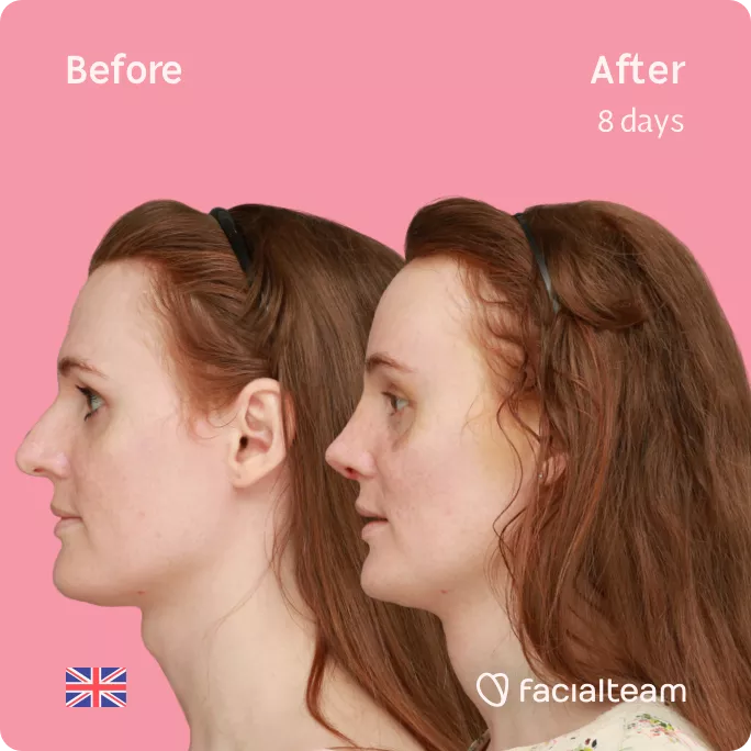 Square Side image of FFS patient Charlotte R showing the results before and after facial feminization surgery with Facialteam consisting of tracheal shave, forehead, rhinoplasty feminization surgery.