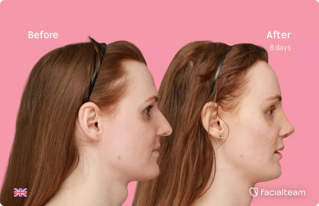 Right Side image of FFS patient Charlotte R showing the results before and after facial feminization surgery with Facialteam consisting of tracheal shave, forehead, rhinoplasty feminization surgery.