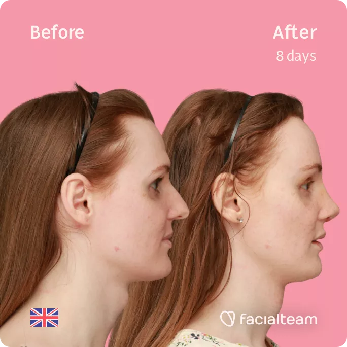 Square right side image of FFS patient Charlotte R showing the results before and after facial feminization surgery with Facialteam consisting of tracheal shave, forehead, rhinoplasty feminization surgery.