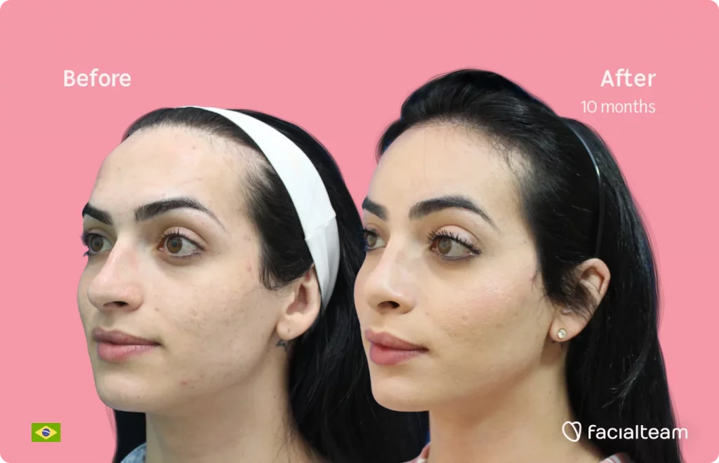 Left side 45 degree image of FFS patient Julia S showing the results before and after facial feminization surgery consisting of tracheal shave, forehead, rhinoplasty feminization surgery.
