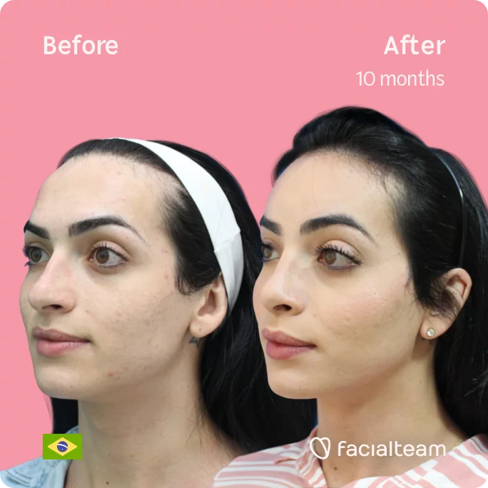 Left side square 45 degree image of FFS patient Julia S showing the results before and after facial feminization surgery consisting of tracheal shave, forehead, rhinoplasty feminization surgery.
