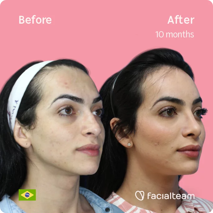 Square 45 degree image of FFS patient Julia S showing the results before and after facial feminization surgery consisting of tracheal shave, forehead, rhinoplasty feminization surgery.
