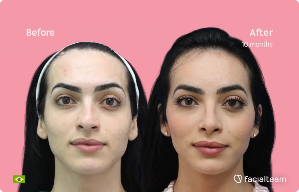 Frontal image of FFS patient Julia S showing the results before and after facial feminization surgery with Facialteam consisting of tracheal shave, forehead, rhinoplasty feminization surgery.