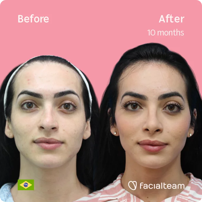 Square frontal image of FFS patient Julia S showing the results before and after facial feminization surgery with Facialteam consisting of tracheal shave, forehead, rhinoplasty feminization surgery.