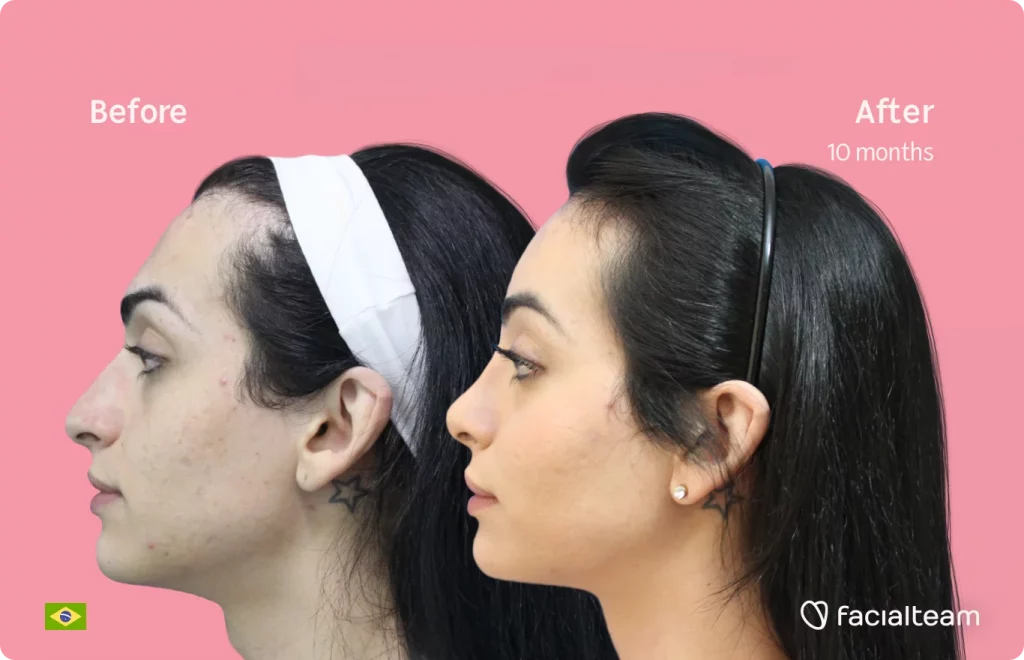 Side image of FFS patient Julia S showing the results before and after facial feminization surgery with Facialteam consisting of tracheal shave, forehead, rhinoplasty feminization surgery.