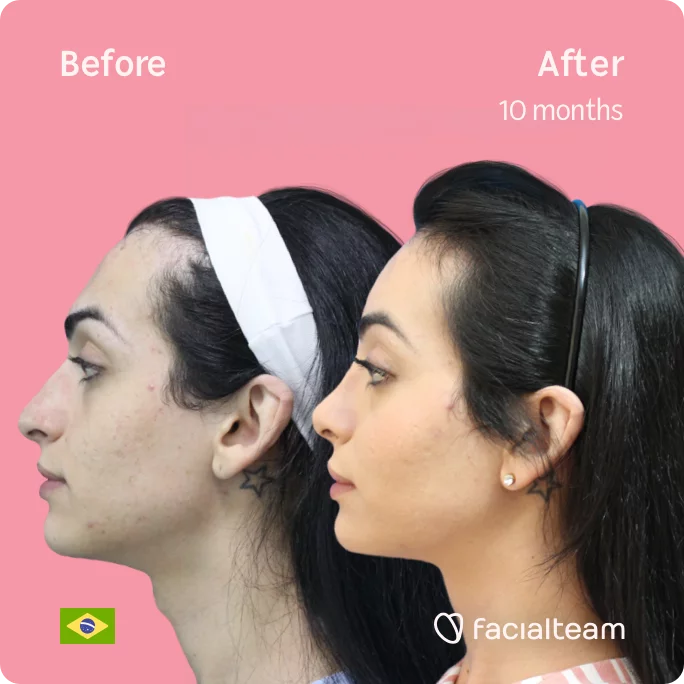 Square Side image of FFS patient Julia S showing the results before and after facial feminization surgery with Facialteam consisting of tracheal shave, forehead, rhinoplasty feminization surgery.