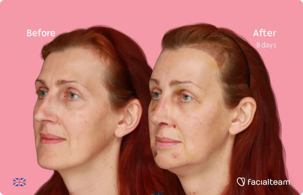 45 degree image of FFS patient Sophie showing the results before and after facial feminization surgery consisting of tracheal shave, forehead with SHT, jaw, chin, rhinoplasty feminization surgery.