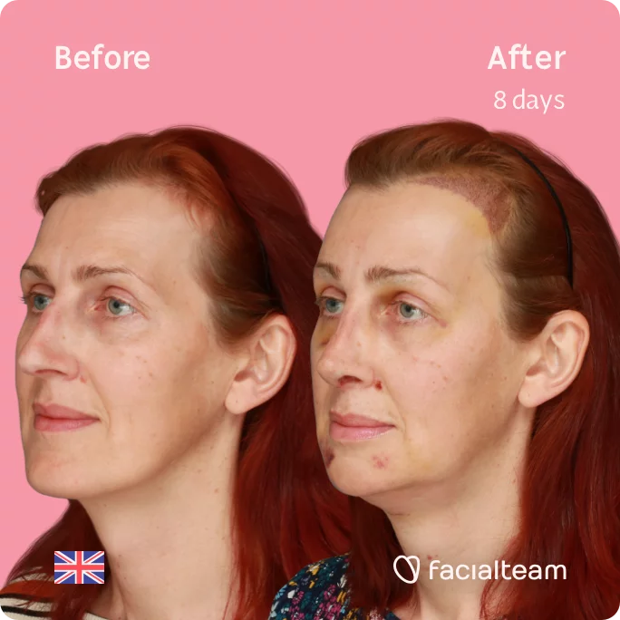 Square 45 degree image of FFS patient Sophie showing the results before and after facial feminization surgery consisting of tracheal shave, forehead with SHT, jaw, chin, rhinoplasty feminization surgery.