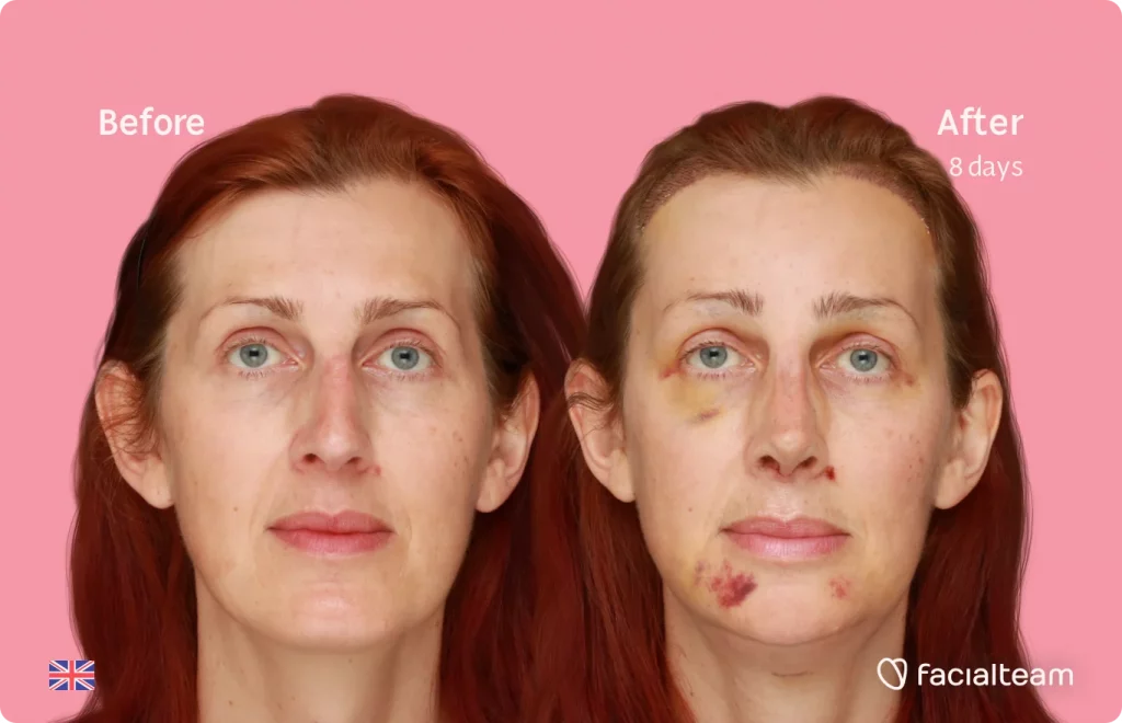 Frontal image of FFS patient Sophie showing the results before and after facial feminization surgery with Facialteam consisting of tracheal shave, forehead with SHT, jaw, chin, rhinoplasty feminization surgery.