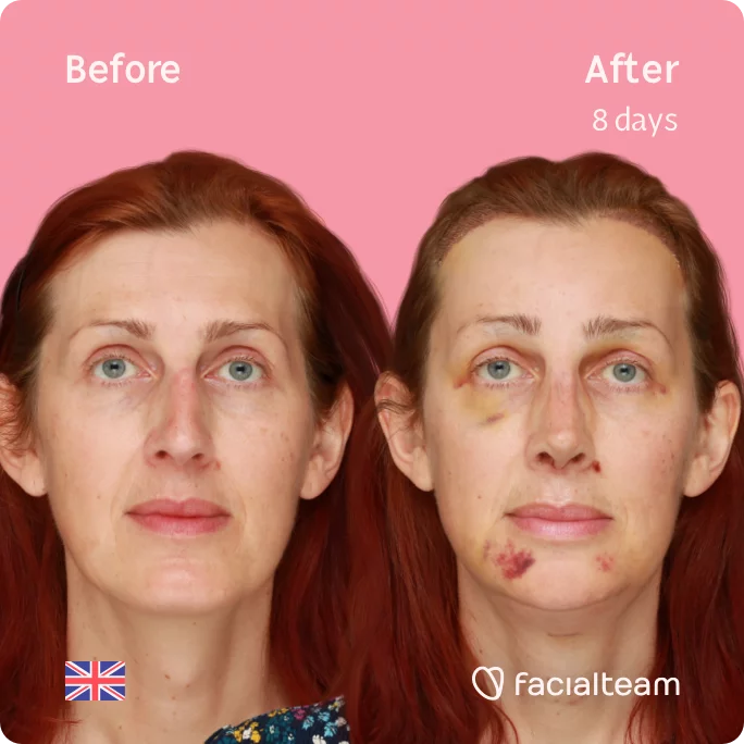 Square frontal image of FFS patient Sophie showing the results before and after facial feminization surgery with Facialteam consisting of tracheal shave, forehead with SHT, jaw, chin, rhinoplasty feminization surgery.