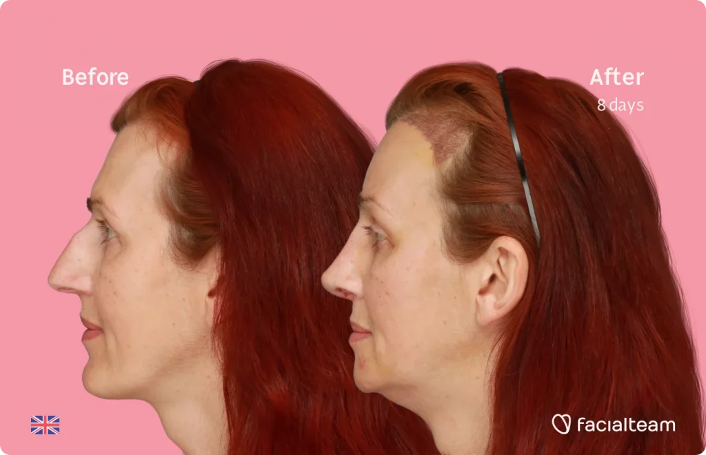 Side image of FFS patient Sophie showing the results before and after facial feminization surgery with Facialteam consisting of tracheal shave, forehead with SHT, jaw, chin, rhinoplasty feminization surgery.