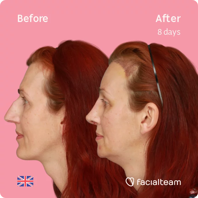 Square Side image of FFS patient Sophie showing the results before and after facial feminization surgery with Facialteam consisting of tracheal shave, forehead with SHT, jaw, chin, rhinoplasty feminization surgery.