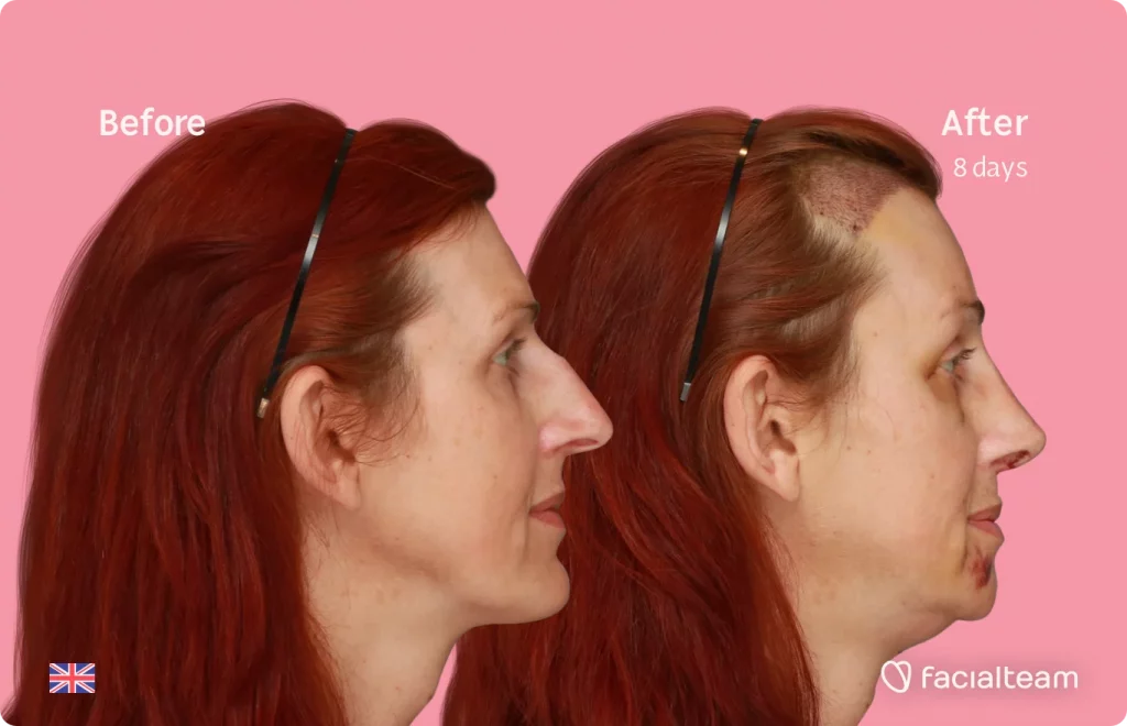 Right side image of FFS patient Sophie showing the results before and after facial feminization surgery with Facialteam consisting of tracheal shave, forehead with SHT, jaw, chin, rhinoplasty feminization surgery.