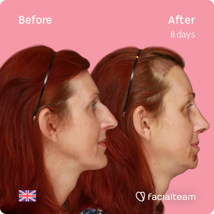 Square right side image of FFS patient Sophie showing the results before and after facial feminization surgery with Facialteam consisting of tracheal shave, forehead with SHT, jaw, chin, rhinoplasty feminization surgery.