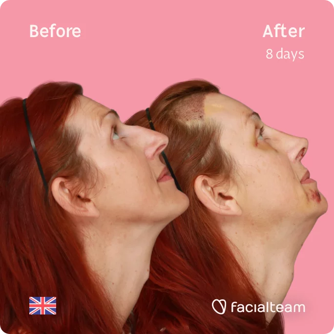 Square Side image of FFS patient Sophie looking up showing the results before and after facial feminization surgery with Facialteam consisting of tracheal shave, forehead with SHT, jaw, chin, rhinoplasty feminization surgery.