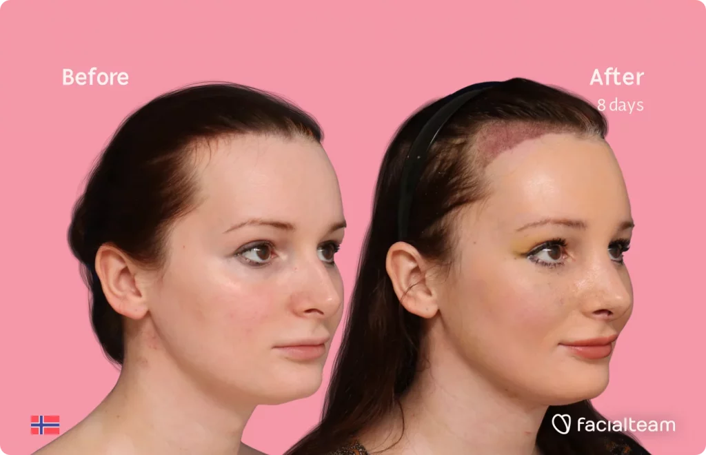 45 degree image of FFS patient Victoria showing the results before and after facial feminization surgery consisting of tracheal shave, forehead with SHT, rhinoplasty feminization surgery.