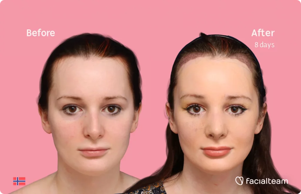 Frontal image of FFS patient Victoria showing the results before and after facial feminization surgery with Facialteam consisting of tracheal shave, forehead with SHT, rhinoplasty feminization surgery.