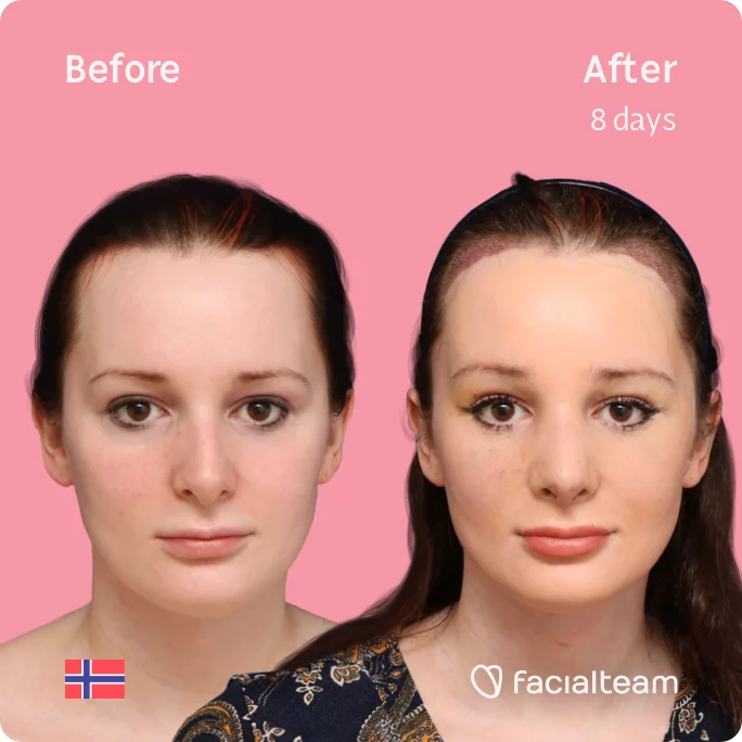 Square frontal image of FFS patient Victoria showing the results before and after facial feminization surgery with Facialteam consisting of tracheal shave, forehead with SHT, rhinoplasty feminization surgery.