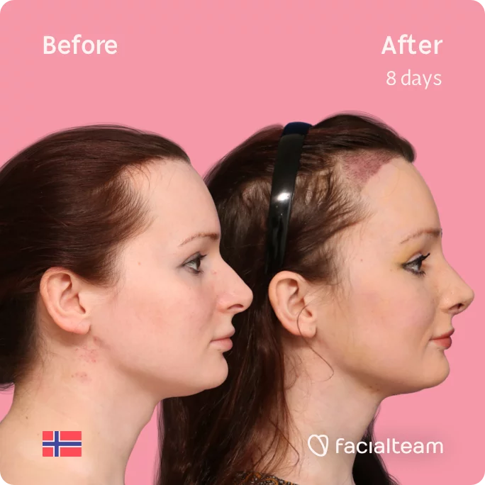 Square Side image of FFS patient Victoria showing the results before and after facial feminization surgery with Facialteam consisting of tracheal shave, forehead with SHT, rhinoplasty feminization surgery.