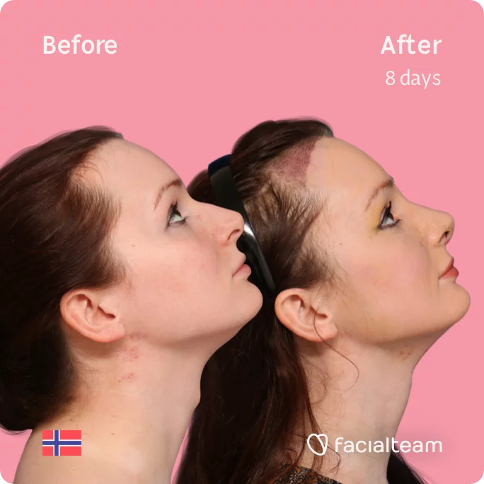 Square Side image of FFS patient Victoria looking up showing the results before and after facial feminization surgery with Facialteam consisting of tracheal shave, forehead with SHT, rhinoplasty feminization surgery.