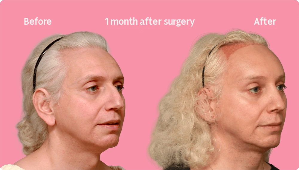 Image of a Facialteam patient showing the result of a hair transplant. This image illustrates the hairline before and after the hair transplant, showing the growth back rate after 1 month.