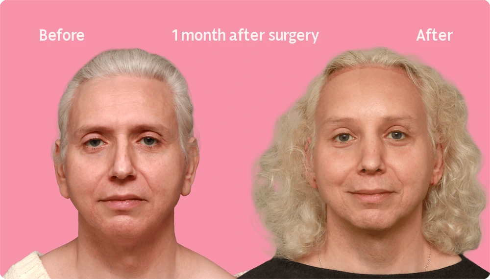 Frontal image of a Facialteam patient showing the result of a hair transplant. This image illustrates the hairline before and after the hair transplant, showing the growth back rate after 1 month.