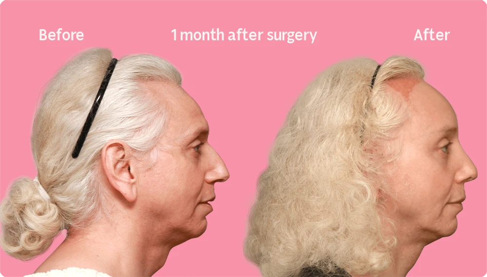 Side image of a Facialteam patient showing the result of a hair transplant. This image illustrates the hairline before and after the hair transplant, showing the growth back rate after 1 month.