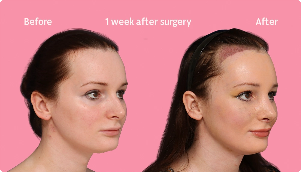 Image of a Facialteam patient showing the result of a hair transplant. This image illustrates the hairline before and after the hair transplant, showing the growth back rate after 1 week. 