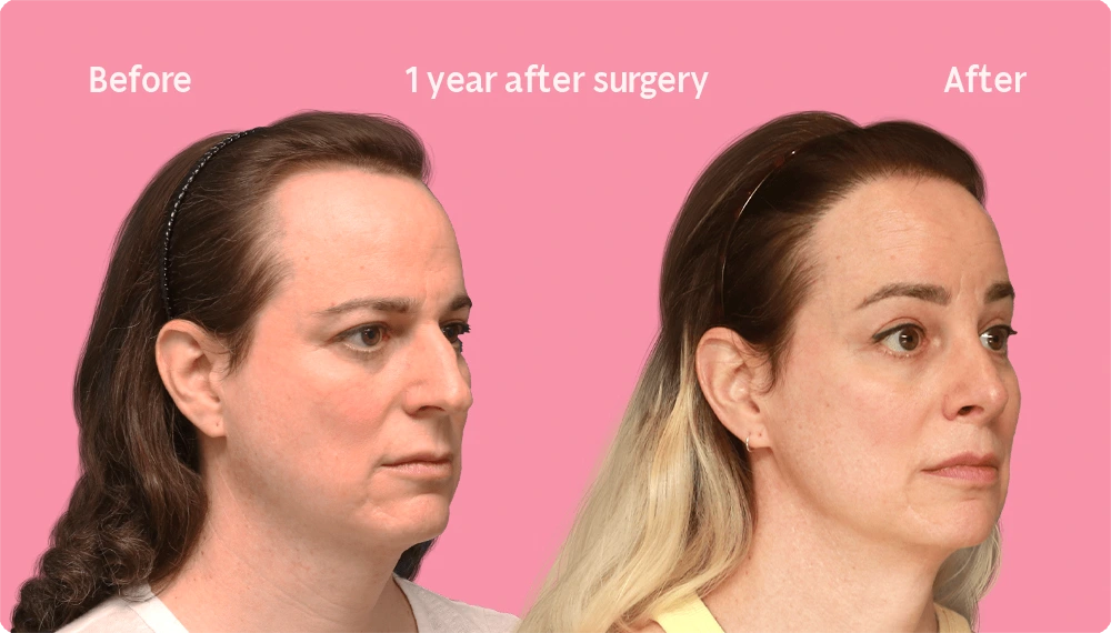 Image of a Facialteam patient showing the result of a hair transplant. This image illustrates the hairline before and after the hair transplant, showing the growth back rate after 1 year.
