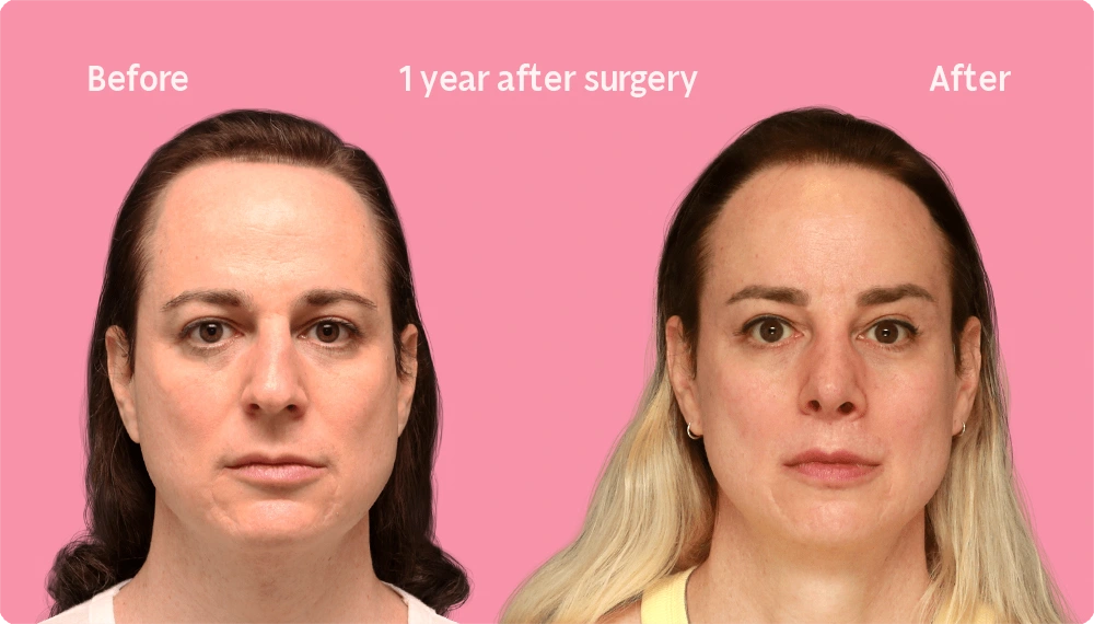 Frontal image of a Facialteam patient showing the result of a hair transplant. This image illustrates the hairline before and after the hair transplant, showing the growth back rate after 1 year.