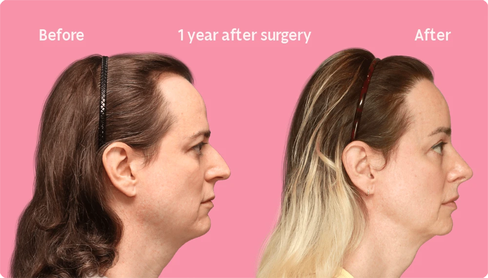 Side image of a Facialteam patient showing the result of a hair transplant. This image illustrates the hairline before and after the hair transplant, showing the growth back rate after 1 year.