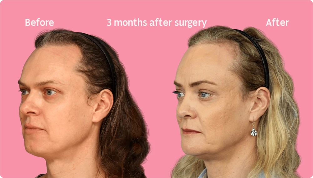 Image of a Facialteam patient showing the result of a hair transplant. This image illustrates the hairline before and after the hair transplant, showing the growth back rate after 3 months.