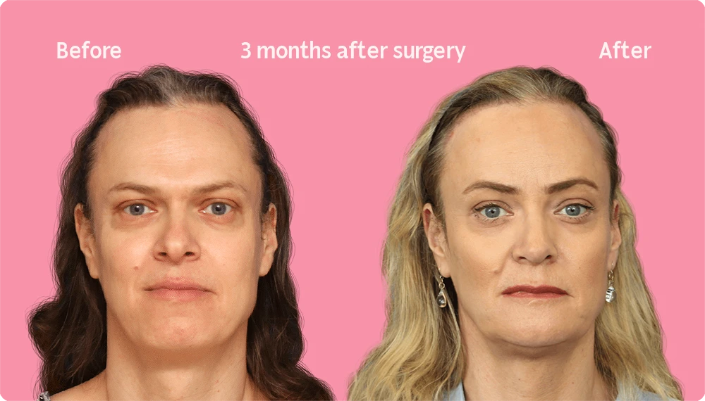 Frontal image of a Facialteam patient showing the result of a hair transplant. This image illustrates the hairline before and after the hair transplant, showing the growth back rate after 3 months.