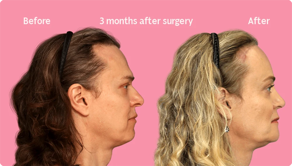 Side image of a Facialteam patient showing the result of a hair transplant. This image illustrates the hairline before and after the hair transplant, showing the growth back rate after 3 months.