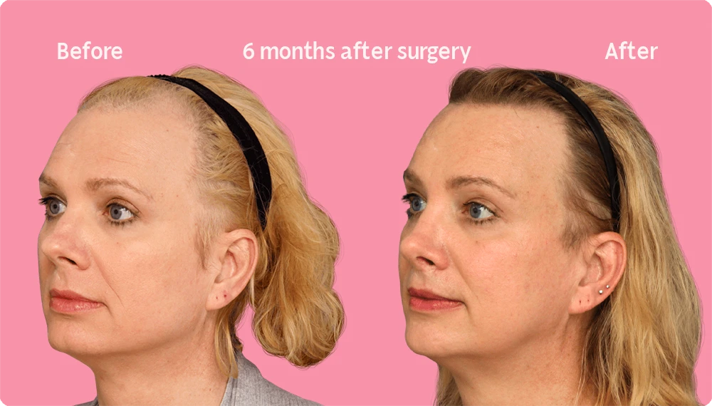 Image of a Facialteam patient showing the result of a hair transplant. This image illustrates the hairline before and after the hair transplant, showing the growth back rate after 6 months.