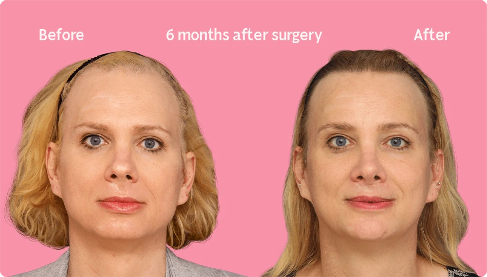 Frontal image of a Facialteam patient showing the result of a hair transplant. This image illustrates the hairline before and after the hair transplant, showing the growth back rate after 6 months.