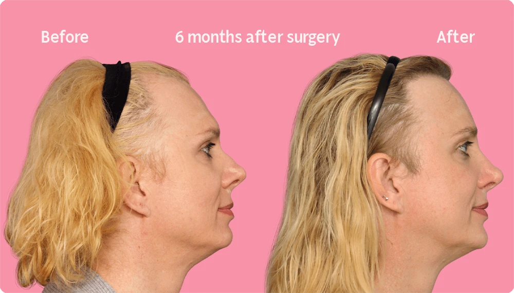 Side image of a Facialteam patient showing the result of a hair transplant. This image illustrates the hairline before and after the hair transplant, showing the growth back rate after 6 months.