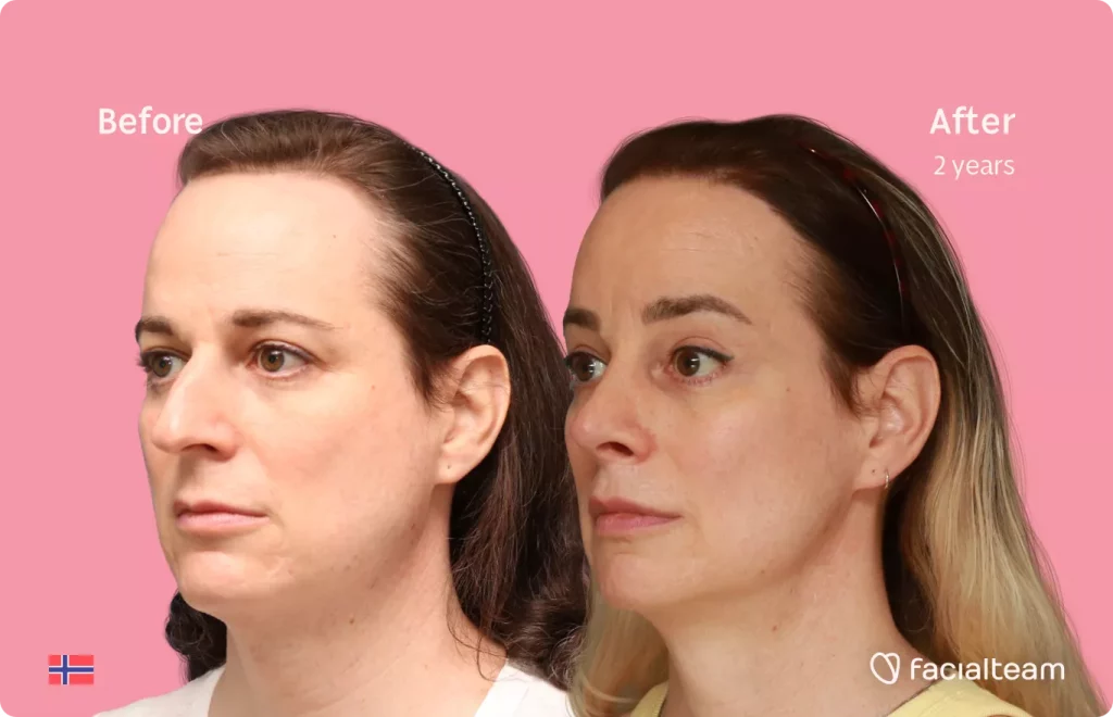 45 degree left angle image of FFS patient Jennifer B showing the results before and after facial feminization surgery with Facialteam consisting of rhinoplasty, forehead with SHT, jaw, chin and lip feminization surgery.