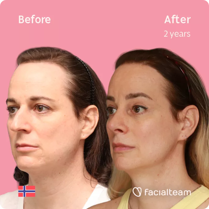 Square 45 degree left angle image of FFS patient Jennifer B showing the results before and after facial feminization surgery with Facialteam consisting of rhinoplasty, forehead with SHT, jaw, chin and lip feminization surgery.