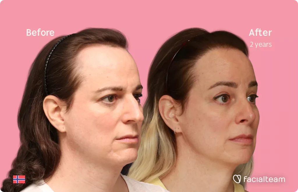 45 degree right angle image of FFS patient Jennifer B showing the results before and after facial feminization surgery with Facialteam consisting of rhinoplasty, forehead with SHT, jaw, chin and lip feminization surgery.