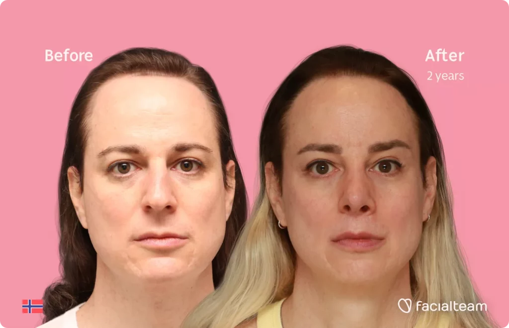 Frontal image of FFS patient Jennifer B showing the results before and after facial feminization surgery with Facialteam consisting of rhinoplasty, forehead with SHT, jaw, chin and lip feminization surgery.