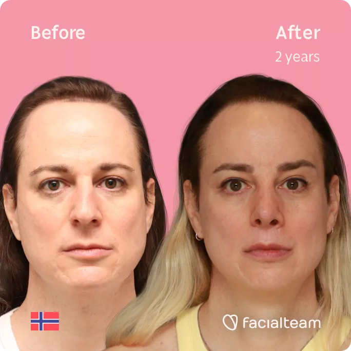 Square frontal image of FFS patient Jennifer B showing the results before and after facial feminization surgery with Facialteam consisting of rhinoplasty, forehead with SHT, jaw, chin and lip feminization surgery.