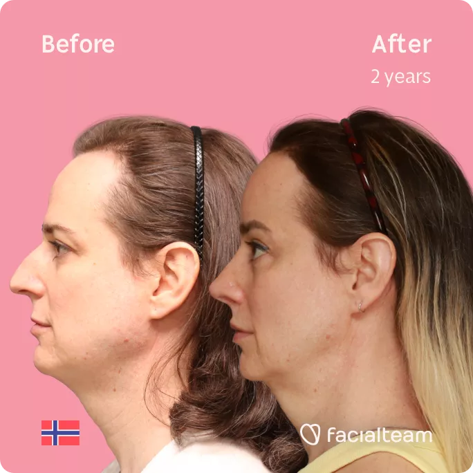 Square left side image of FFS patient Jennifer B showing the results before and after facial feminization surgery with Facialteam consisting of rhinoplasty, forehead with SHT, jaw, chin and lip feminization surgery.