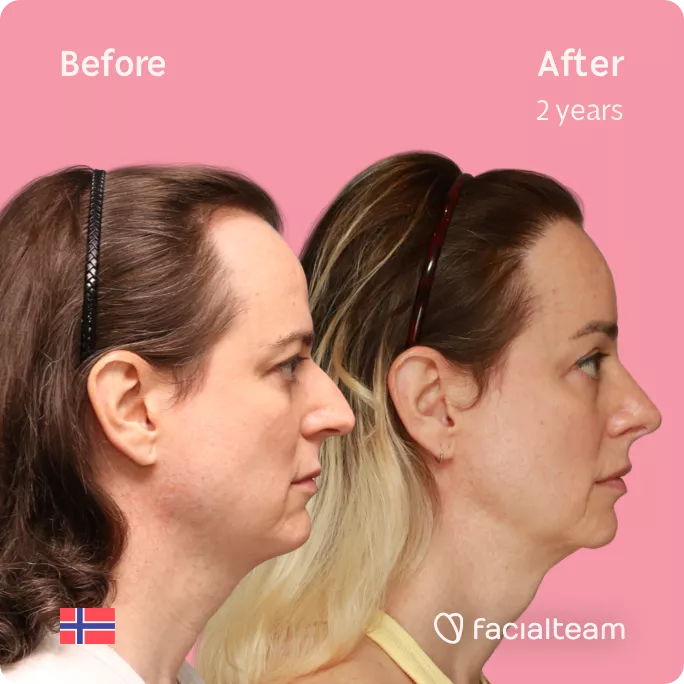 Square right side image of FFS patient Jennifer B showing the results before and after facial feminization surgery with Facialteam consisting of rhinoplasty, forehead with SHT, jaw, chin and lip feminization surgery.