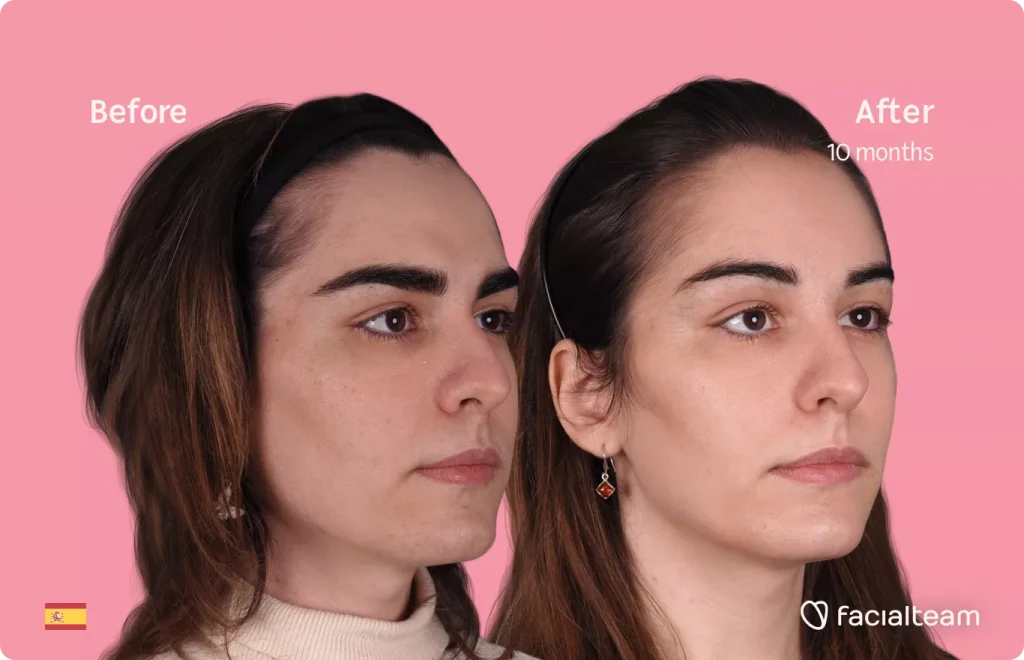 45 degree right angle image of FFS patient Mar showing the results before and after facial feminization surgery with Facialteam consisting of forehead feminization.
