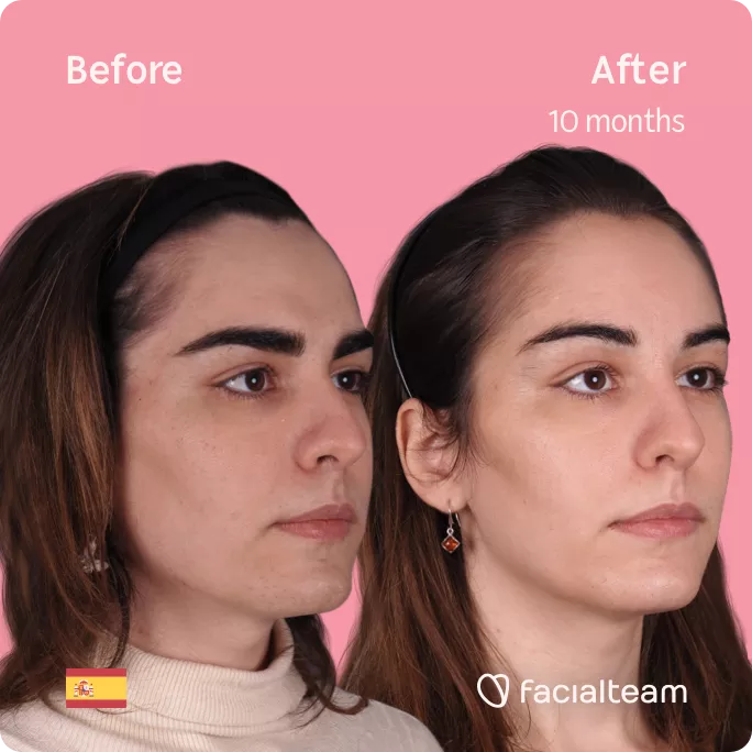 Square 45 degree right angle image of FFS patient Mar showing the results before and after facial feminization surgery with Facialteam consisting of forehead feminization.