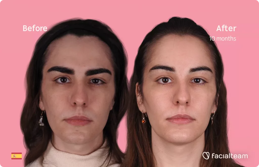 Frontal image of FFS patient Mar showing the results before and after facial feminization surgery with Facialteam consisting of forehead feminization.