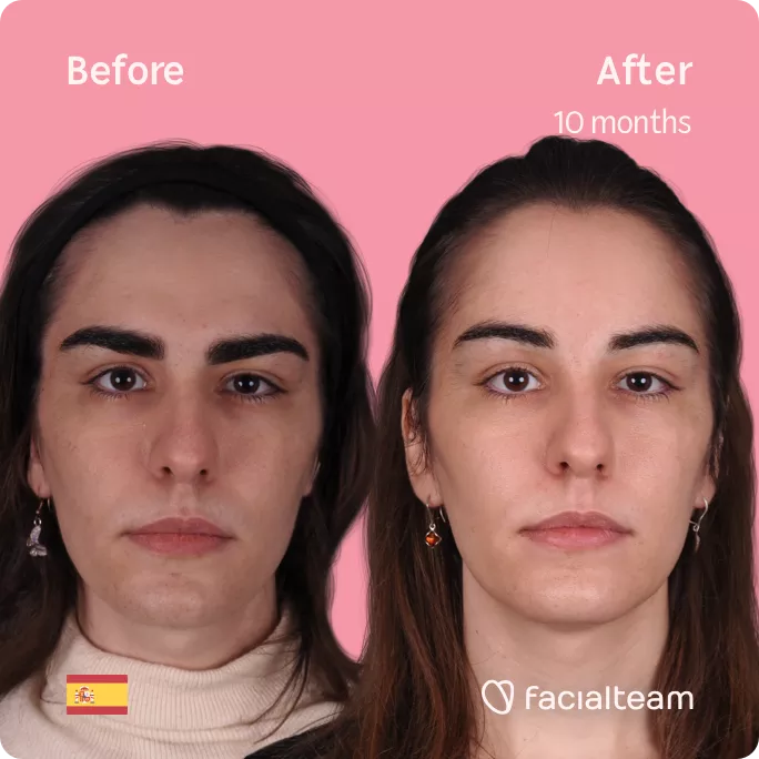 Square frontal image of FFS patient Mar showing the results before and after facial feminization surgery with Facialteam consisting of forehead feminization.