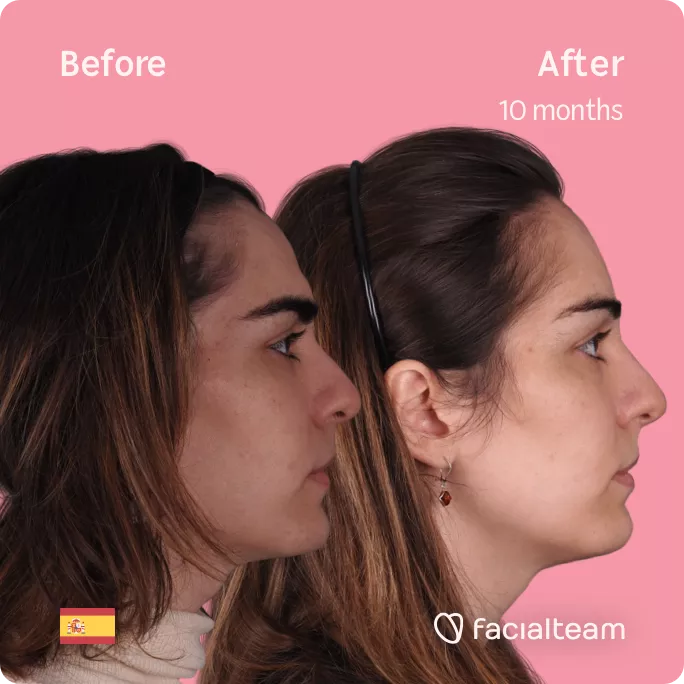Square side image of FFS patient Mar showing the results before and after facial feminization surgery with Facialteam consisting of forehead feminization.
